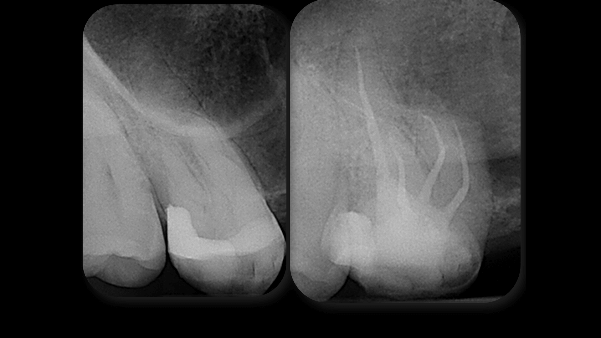 Blocked Canals - Case 4